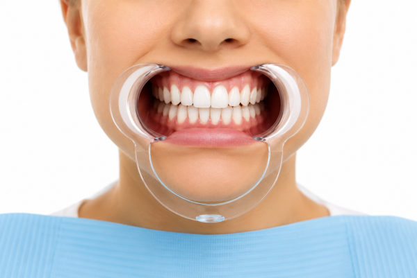 Transparent Type C lip and cheek retractor for improved visibility during dental procedures and photography. Image Description VIDU Type C Lip & Cheek Retractor supplied as a pack of two. Manufactured from transparent, latex-free plastic and suitable for dental photography, whitening procedures and general clinical use. Autoclavable at 121°C.